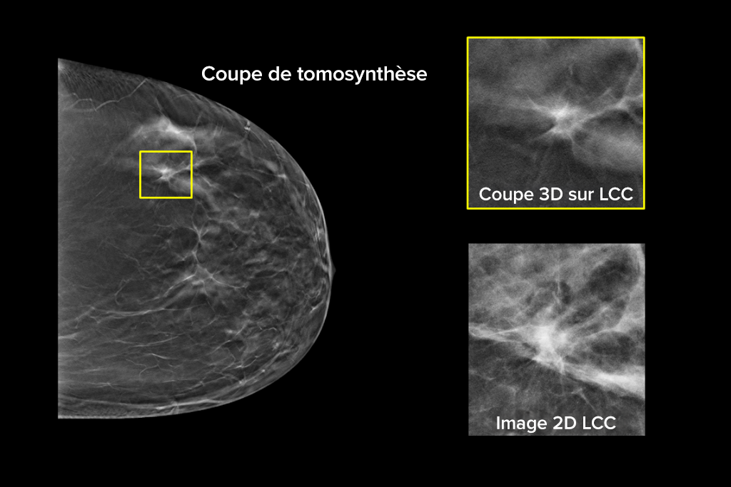 Images cliniques d’une mammographie sur un sein graisseux
