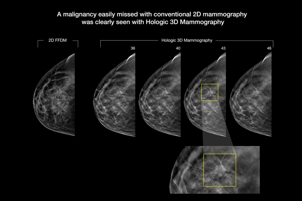 Clinical images of breast scan mammography