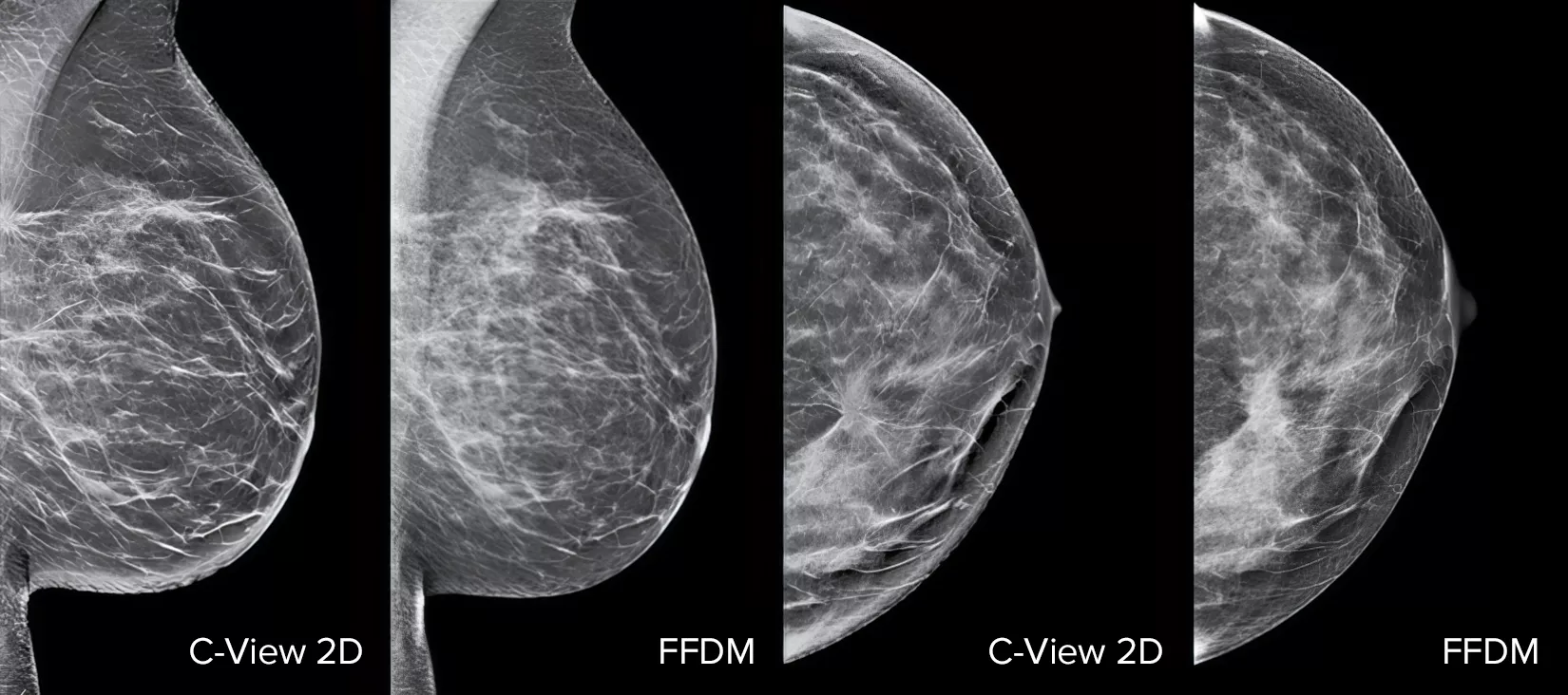 C-View 2D vs FFDM breast x-ray images